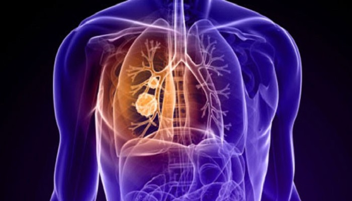 ابتلای روزانه ۳۰ نفر به سل در کشور/ تشخیص سل به دلیل تشابه علائم تنفسی با کرونا سخت‌تر‌ شده است
